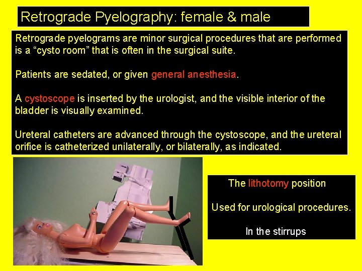 Retrograde Pyelography: female & male Retrograde pyelograms are minor surgical procedures that are performed
