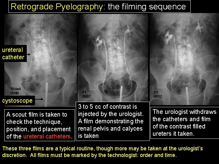 Retrograde Pyelography: the filming sequence ureteral catheter Scout 0900 cystoscope #1 0907 3 to