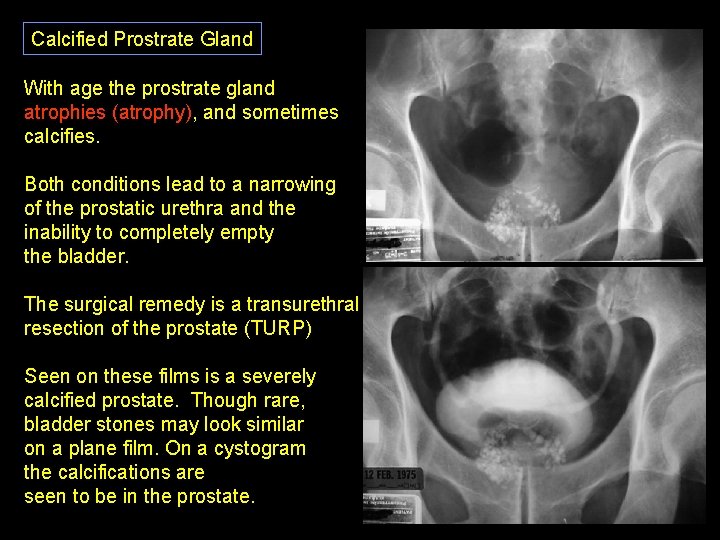 Calcified Prostrate Gland With age the prostrate gland atrophies (atrophy), and sometimes calcifies. Both