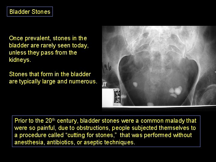 Bladder Stones Once prevalent, stones in the bladder are rarely seen today, unless they