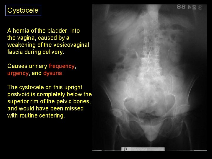 Cystocele A hernia of the bladder, into the vagina, caused by a weakening of