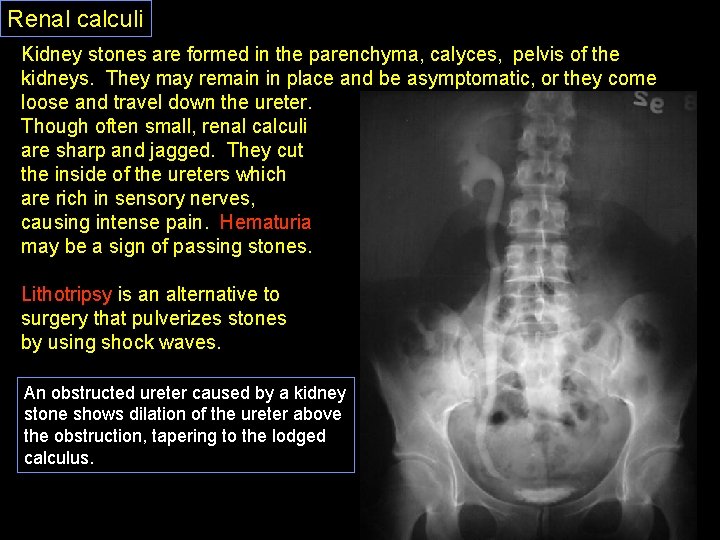 Renal calculi Kidney stones are formed in the parenchyma, calyces, pelvis of the kidneys.