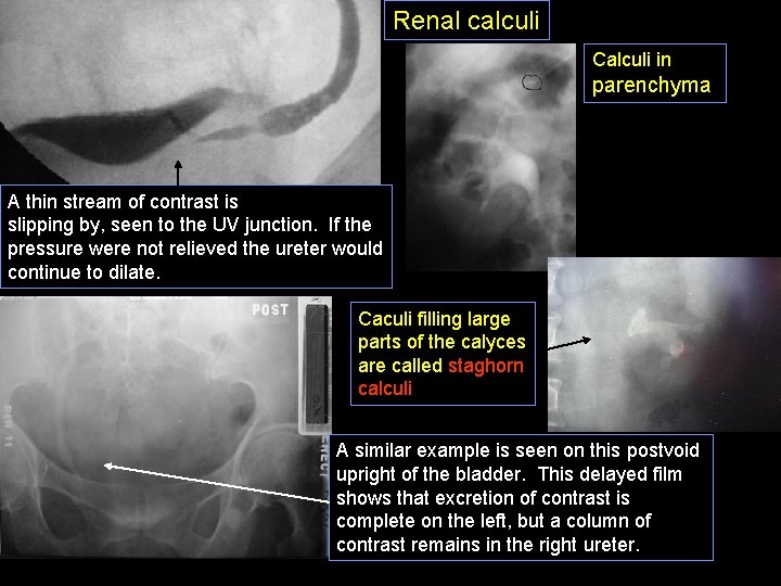 Renal calculi Calculi in parenchyma A thin stream of contrast is slipping by, seen