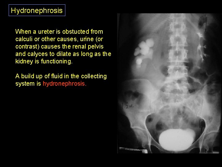 Hydronephrosis When a ureter is obstucted from calculi or other causes, urine (or contrast)