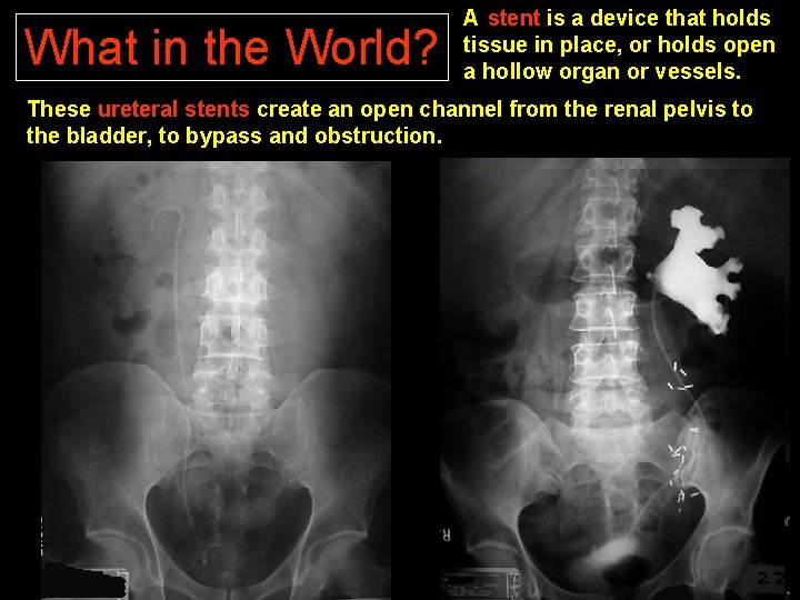 What in the World? A stent is a device that holds tissue in place,