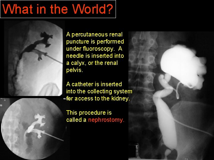 What in the World? A percutaneous renal puncture is performed under fluoroscopy. A needle