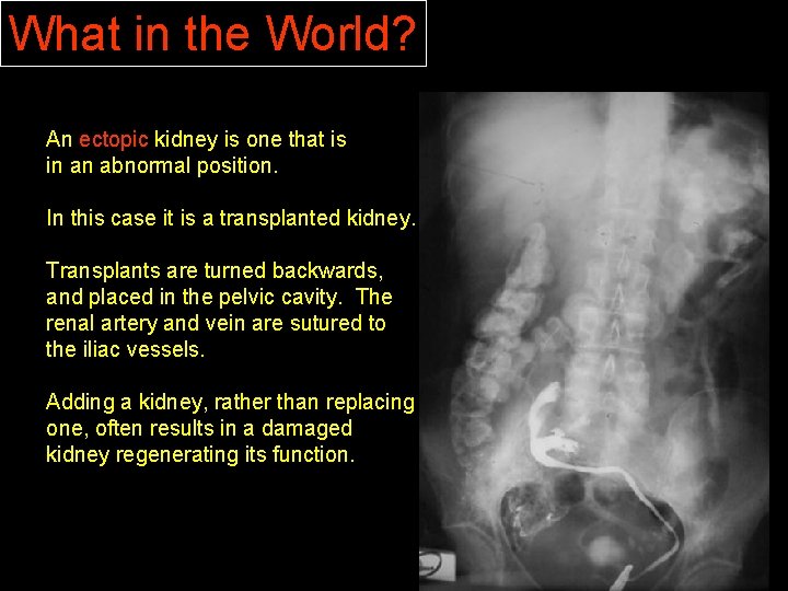 What in the World? An ectopic kidney is one that is in an abnormal