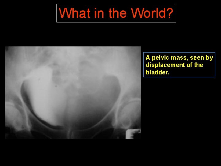 What in the World? A pelvic mass, seen by displacement of the bladder. 