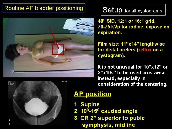 Routine AP bladder positioning Setup for all cystograms 40” SID, 12: 1 or 16: