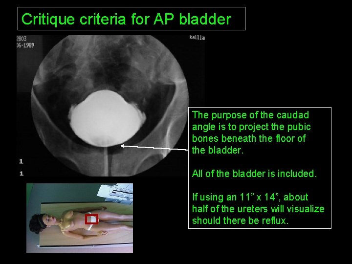 Critique criteria for AP bladder The purpose of the caudad angle is to project