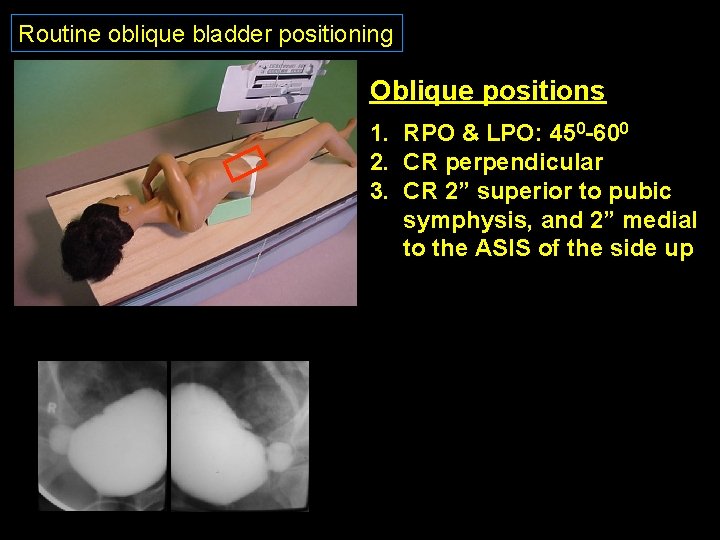 Routine oblique bladder positioning Oblique positions 1. RPO & LPO: 450 -600 2. CR