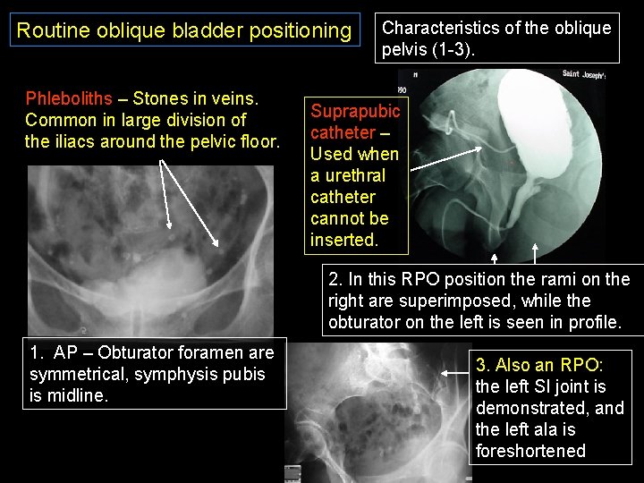 Routine oblique bladder positioning Phleboliths – Stones in veins. Common in large division of