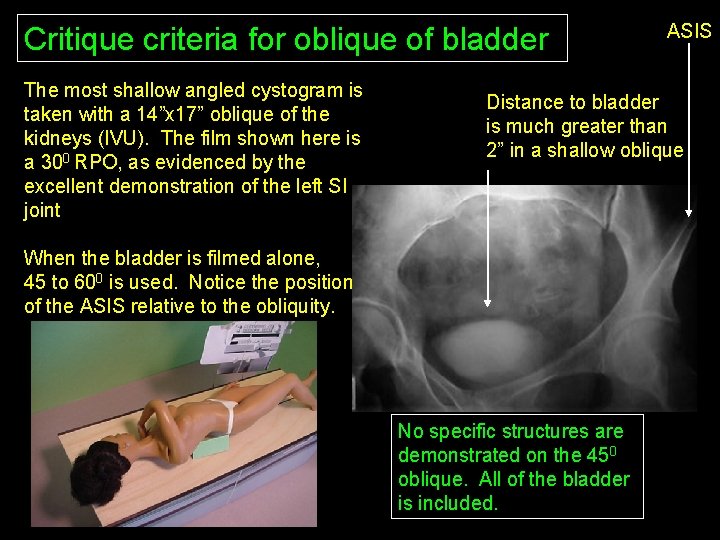 Critique criteria for oblique of bladder The most shallow angled cystogram is taken with