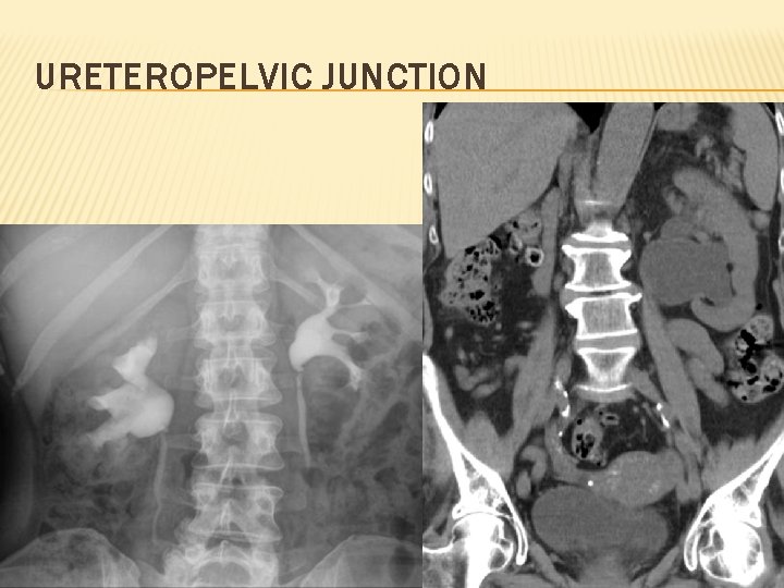 URETEROPELVIC JUNCTION 