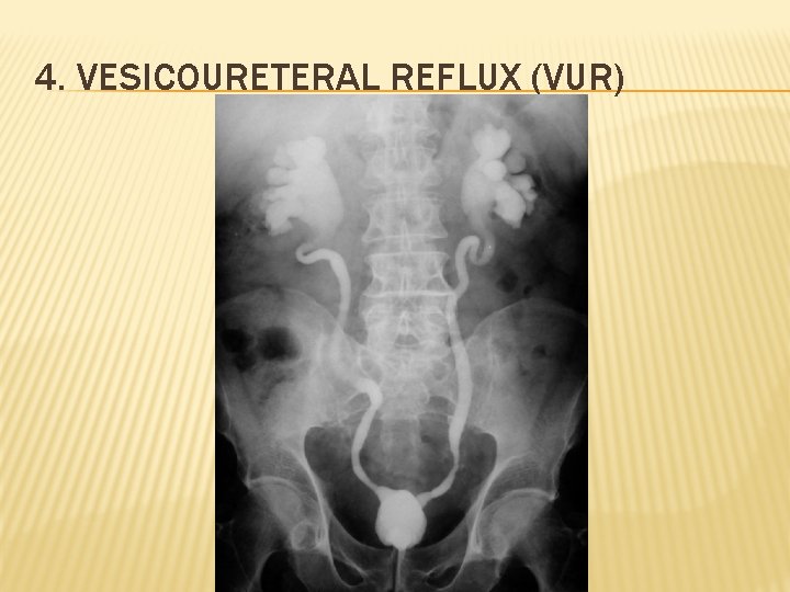 4. VESICOURETERAL REFLUX (VUR) 