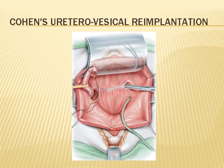 COHEN'S URETERO-VESICAL REIMPLANTATION 