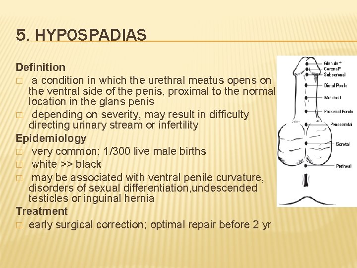 5. HYPOSPADIAS Definition � a condition in which the urethral meatus opens on the