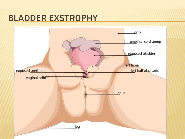 BLADDER EXSTROPHY 