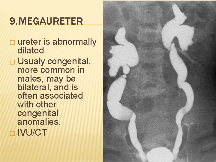 9. MEGAURETER � ureter is abnormally dilated � Usualy congenital, more common in males,