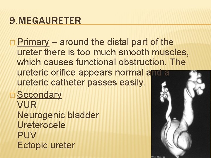 9. MEGAURETER � Primary – around the distal part of the ureter there is