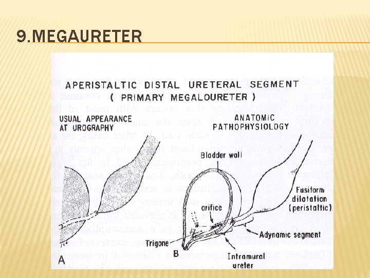 9. MEGAURETER 