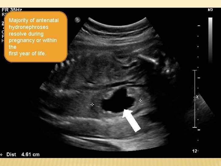 Majority of antenatal hydronephroses resolve during pregnancy or within the first year of life.