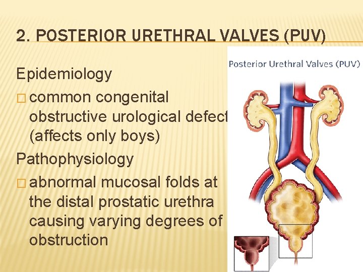 2. POSTERIOR URETHRAL VALVES (PUV) Epidemiology � common congenital obstructive urological defect (affects only