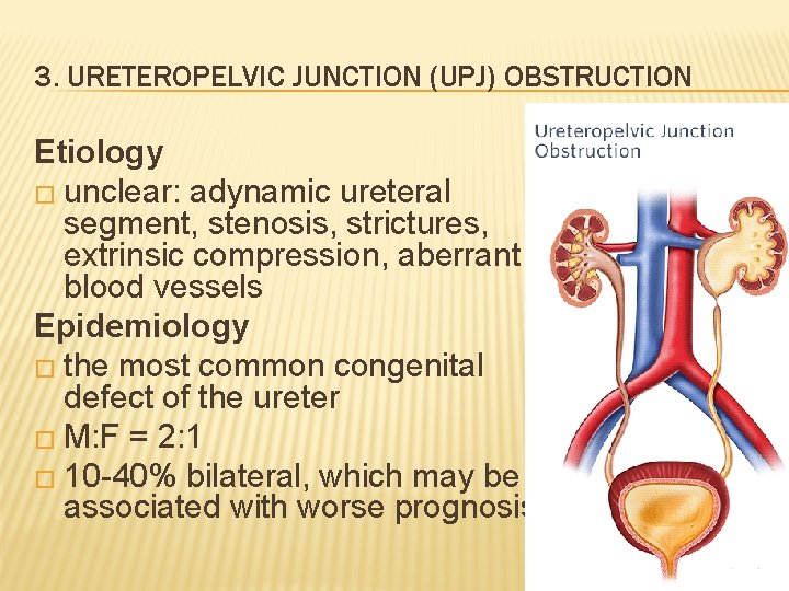 3. URETEROPELVIC JUNCTION (UPJ) OBSTRUCTION Etiology � unclear: adynamic ureteral segment, stenosis, strictures, extrinsic