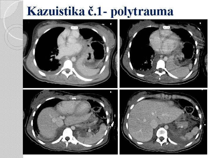 Kazuistika č. 1 - polytrauma 