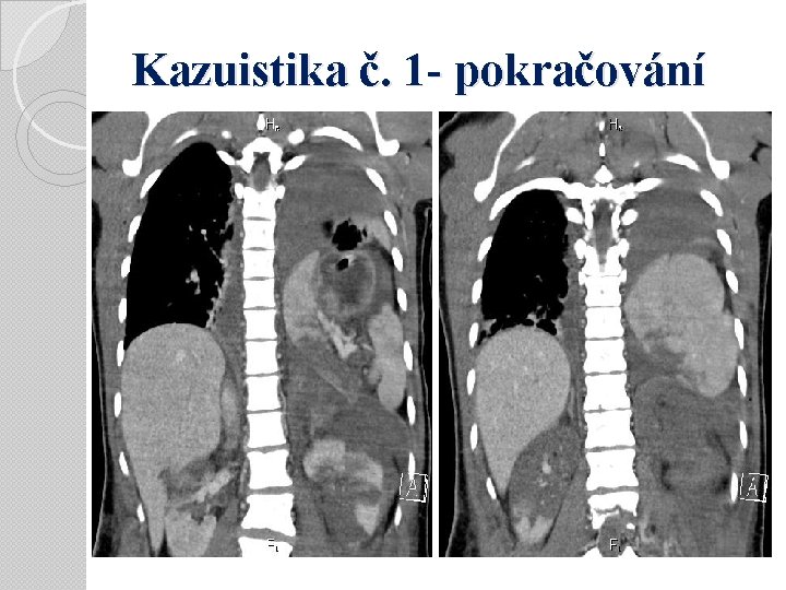 Kazuistika č. 1 - pokračování 