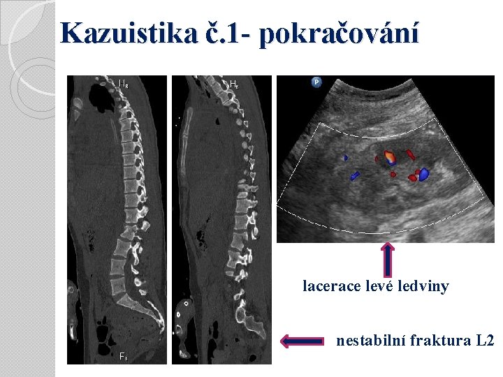 Kazuistika č. 1 - pokračování lacerace levé ledviny nestabilní fraktura L 2 