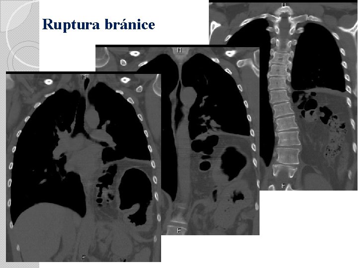 Ruptura bránice 