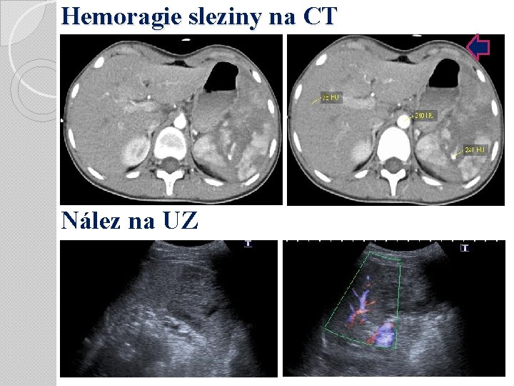 Hemoragie sleziny na CT Nález na UZ 