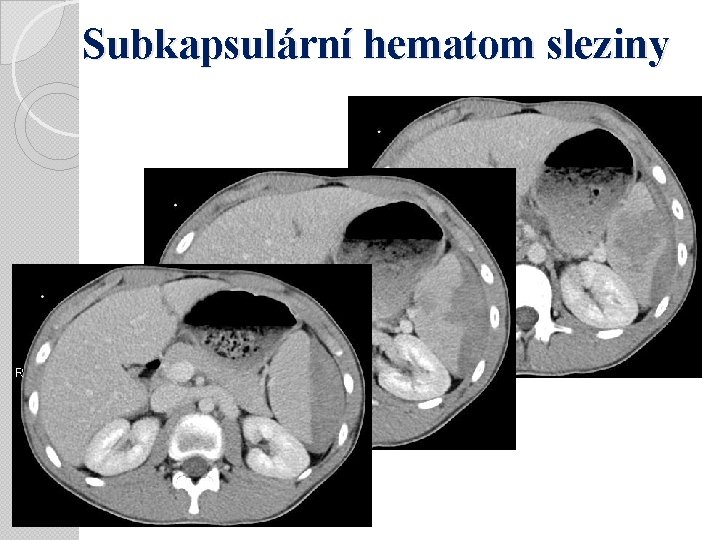 Subkapsulární hematom sleziny 