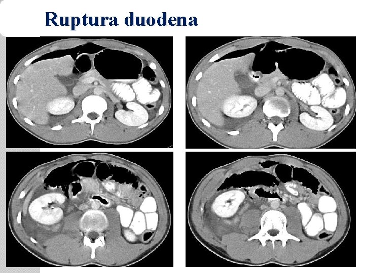 Ruptura duodena 