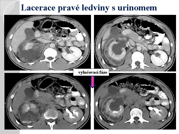 Lacerace pravé ledviny s urinomem vylučovací fáze 