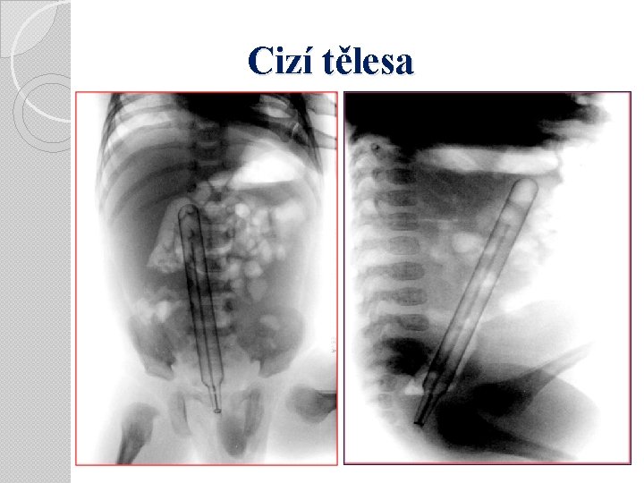 Cizí tělesa 