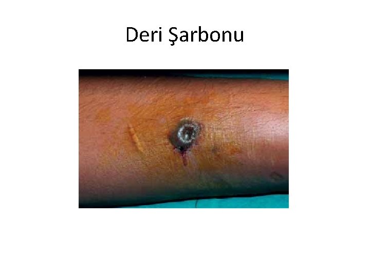 Deri Şarbonu 