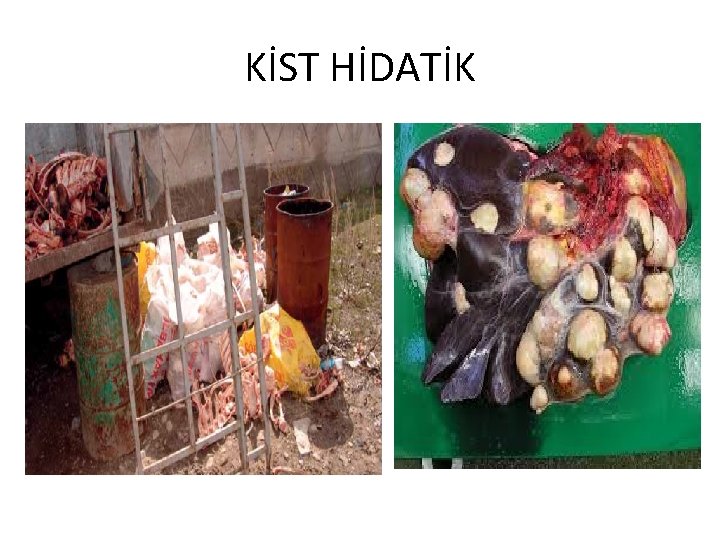 KİST HİDATİK 