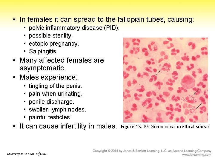  • In females it can spread to the fallopian tubes, causing: • •