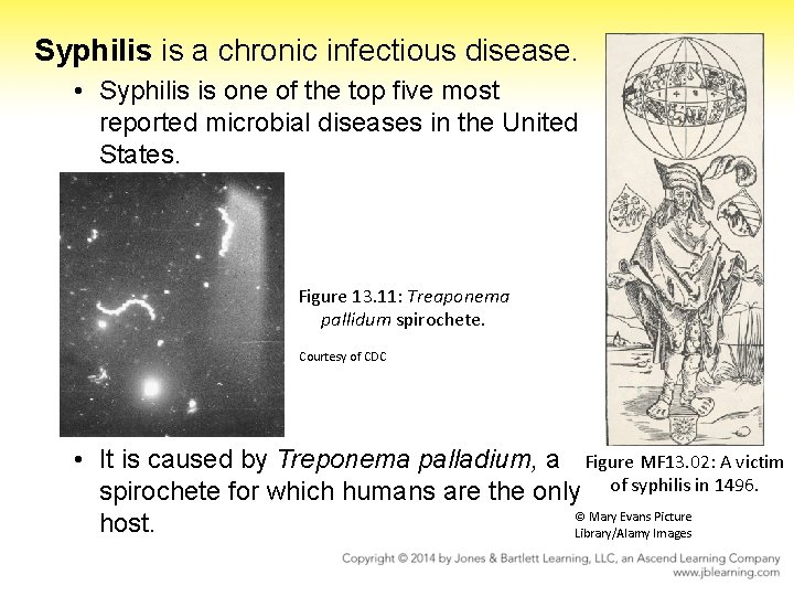 Syphilis is a chronic infectious disease. • Syphilis is one of the top five