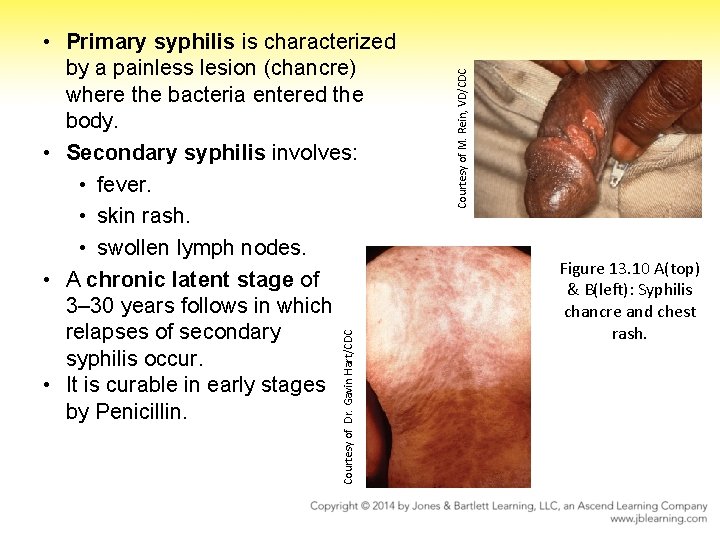 Courtesy of Dr. Gavin Hart/CDC Courtesy of M. Rein, VD/CDC • Primary syphilis is