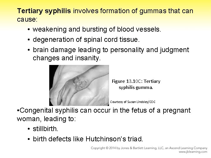 Tertiary syphilis involves formation of gummas that can cause: • weakening and bursting of