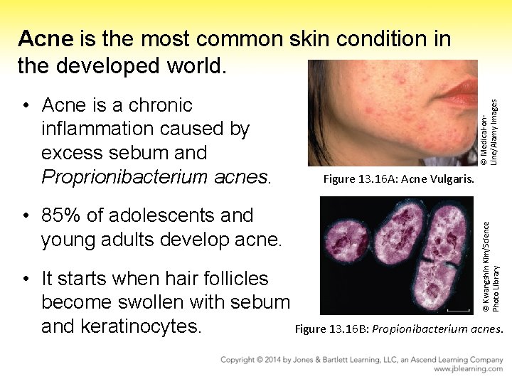  • 85% of adolescents and young adults develop acne. Figure 13. 16 A: