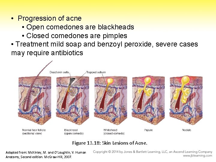  • Progression of acne • Open comedones are blackheads • Closed comedones are