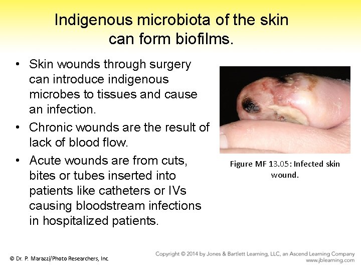 Indigenous microbiota of the skin can form biofilms. • Skin wounds through surgery can