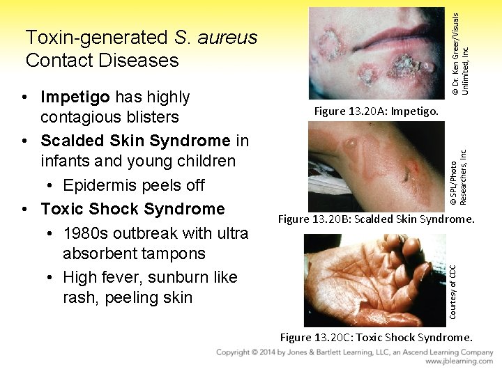 © Dr. Ken Greer/Visuals Unlimited, Inc. Toxin-generated S. aureus Contact Diseases © SPL/Photo Researchers,