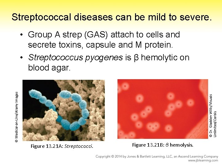 Streptococcal diseases can be mild to severe. © Dr. Gladden Willis/Visuals Unlimited/Corbis. © Medical-on-Line/Alamy