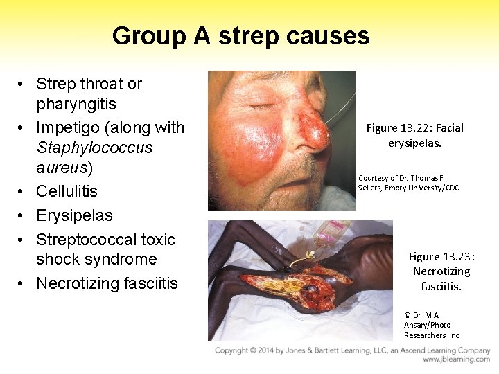 Group A strep causes • Strep throat or pharyngitis • Impetigo (along with Staphylococcus