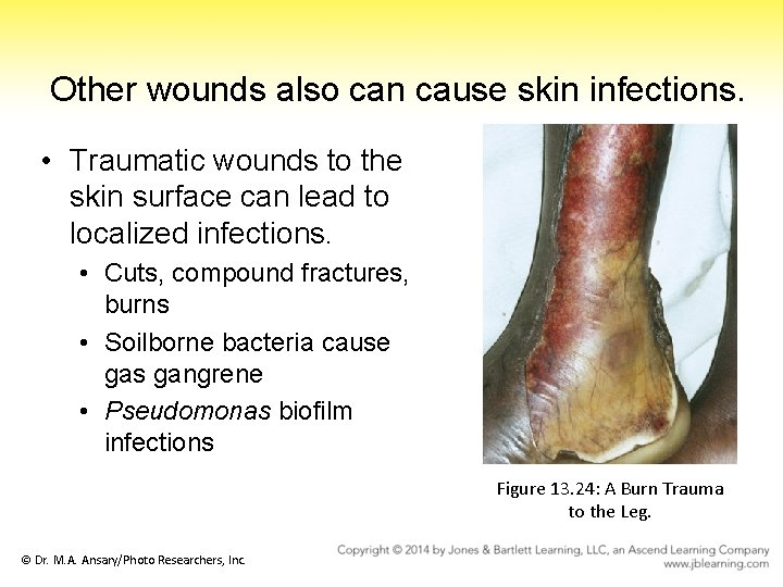 Other wounds also can cause skin infections. • Traumatic wounds to the skin surface